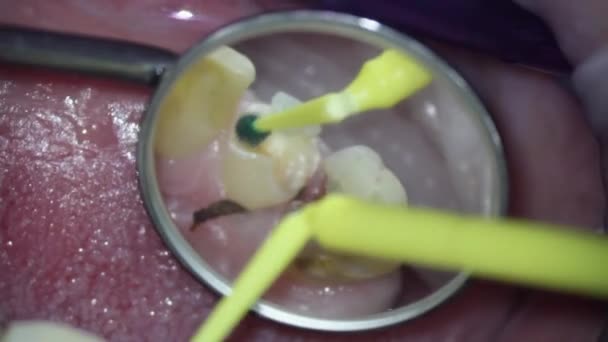 Tandvård. Videofilmning under mikroskop. applicera karies markör på en sjuk tand. Tandbryggning — Stockvideo
