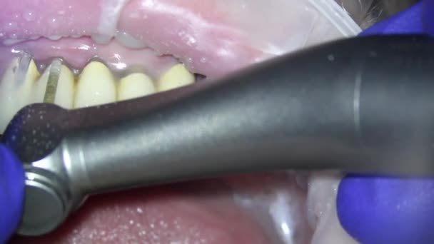 Odontología. filmación de vídeo bajo un microscopio. extracción de un diente de cerámica con un taladro — Vídeo de stock