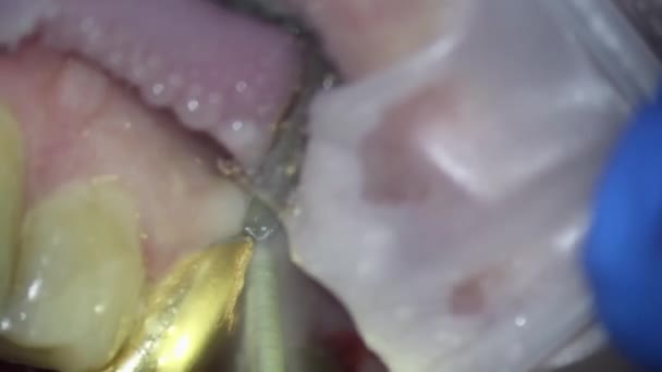 Tandvård. Videofilmning under mikroskop. avlägsnande av en guldkrona på en tand med hjälp av en borr — Stockvideo