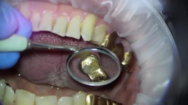 Dentisterie. vidéo filmant au microscope. examen du pont doré de la mâchoire supérieure avec une truelle et un miroir — Video