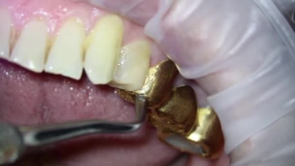 Dentisterie. vidéo filmant au microscope. examen du pont doré de la mâchoire supérieure avec une truelle et un miroir — Video