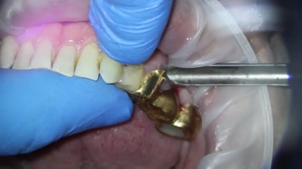 Extracción del puente de oro dental de la mandíbula superior de una persona con un cincel con ascensor — Vídeos de Stock