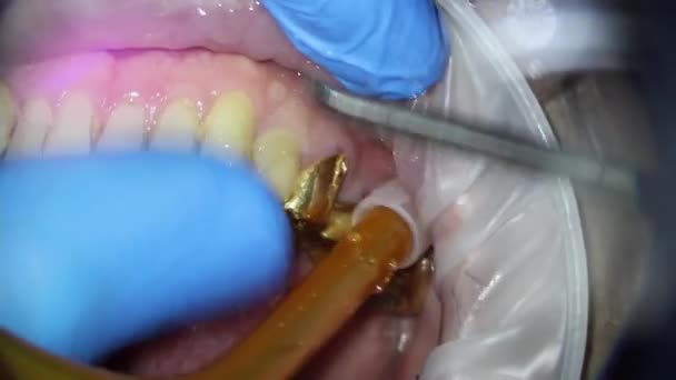Extracción del puente de oro dental de la mandíbula superior de una persona con un cincel con ascensor — Vídeo de stock