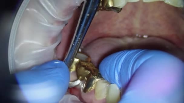 牙科学。在显微镜下拍摄录像。用钩子摘除上颚的金桥 — 图库视频影像