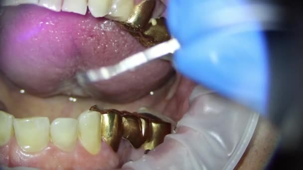Οδοντιατρική. βιντεοσκόπηση κάτω από ένα μικροσκόπιο. αφαίρεση χρυσής στεφάνης σε δόντι με τη χρήση πνευματικού έλικα στεφάνης — Αρχείο Βίντεο
