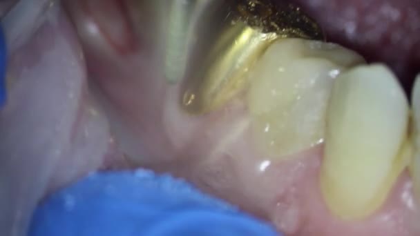 Dentistry. video filming under a microscope. removal of a gold crown on a tooth using a drill — Stock Video