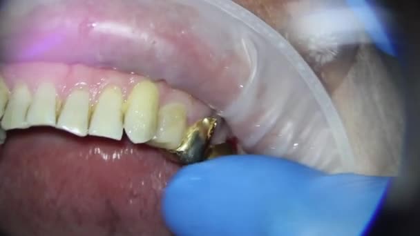Видалення зубного золотого мосту верхньої щелепи людини з стамескою з ліфтом — стокове відео
