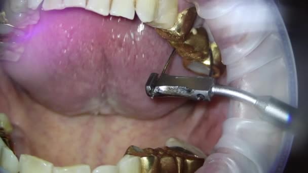 Tandvård. Videofilmning under mikroskop. avlägsnande av en guldkrona på en tand med hjälp av en pneumatisk krondragare — Stockvideo