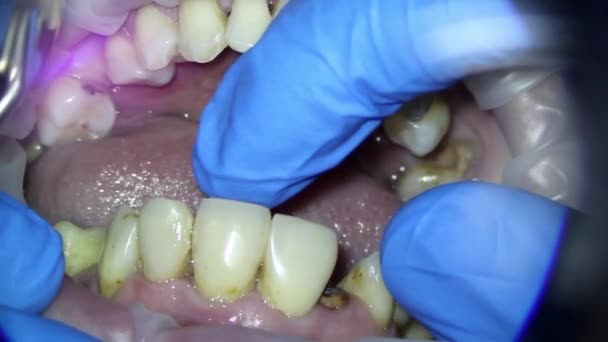 Odontología. filmación de vídeo bajo un microscopio. diagnóstico de una fractura de raíz del diente 21 y una grieta en un diente — Vídeo de stock