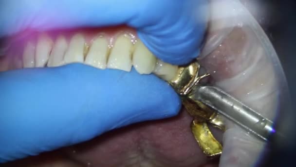 Odstranění zubního zlatého mostu horní čelisti osoby s dlátem s výtahem — Stock video