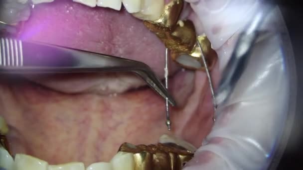 Stomatologii. filmowanie pod mikroskopem. usunięcie złotej korony na zębie za pomocą pneumatycznego ściągacza korony — Wideo stockowe