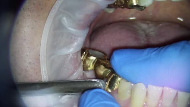 Avlägsnande av den tandgyllene bron över överkäken på en person med mejsel med hiss — Stockvideo