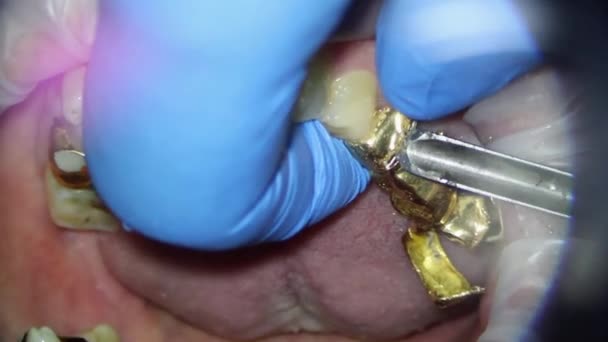 Remoção da ponte dental dourada da mandíbula superior de uma pessoa com um cinzel com um elevador — Vídeo de Stock