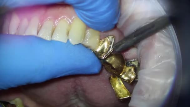 Usunięcie złotego mostu stomatologicznego górnej szczęki osoby z dłutem z windą — Wideo stockowe