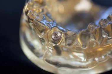 diş implantı modeli