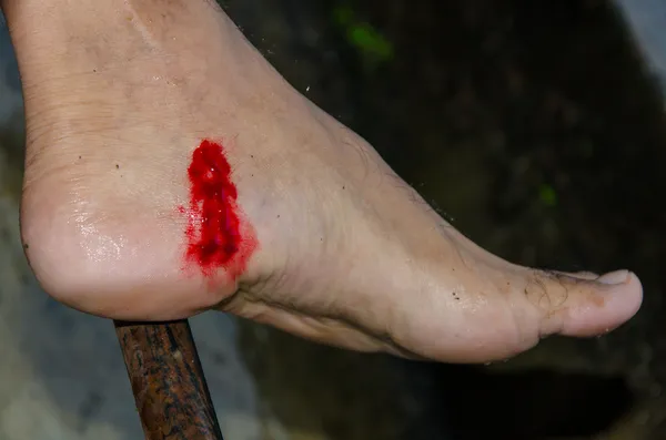 Sår på blodigeln som suger blod från foten — Stockfoto