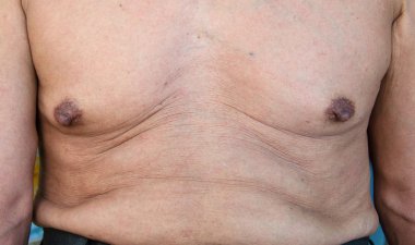 Selülit bir mide ile yaşlı bir adam