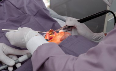 Doktor diş temizleme aletini ultrasonik aletle kullanıyor.