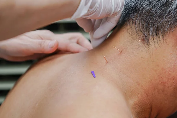 doctor sticks needles into the human body on the acupuncture. Traditional Chinese Medicine. acupuncture treatment.