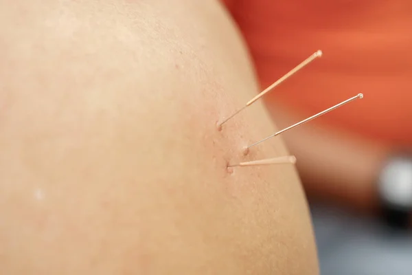 doctor sticks needles into the human body on the acupuncture. Traditional Chinese Medicine. acupuncture treatment.