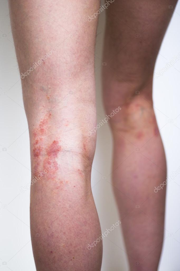 teljes psoriasis kezelsi rend