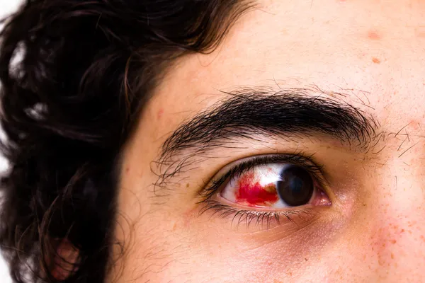 Повреждение глаза — стоковое фото