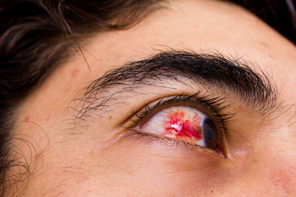 Subconjunctival hemorrhage