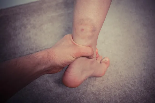 Man grabbing woman's bruised leg — Stock Photo, Image