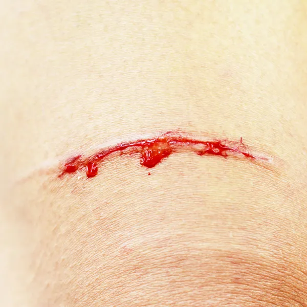腿上的划伤的伤口 — 图库照片