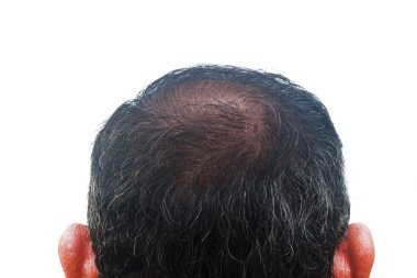 saç dökülmesi ve yeniden oluşturma işlemi, Asya adam 55 yaşında.