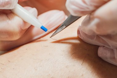 The process of permanent hair removal, removing unwanted hair using an electroepilation device and tweezers, close-up macro photography.