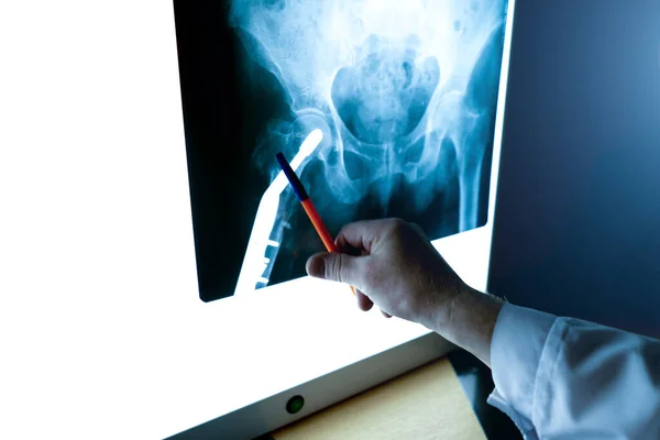 Een Radioloog Onderzoekt Een Röntgenfoto Van Het Heupgewricht Close Rechtenvrije Stockafbeeldingen