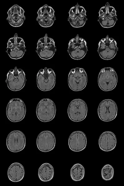 Homme adulte normal cerveau IRM — Photo