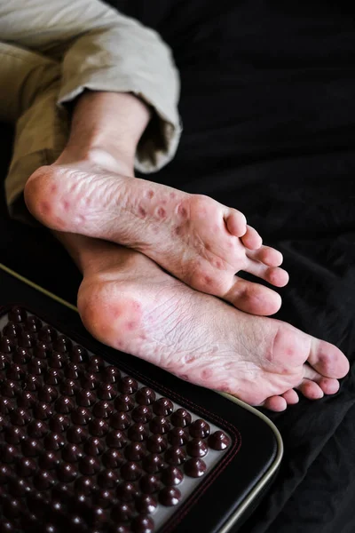 traces from a massager with spikes on the soles of the feet close-up. acupuncture