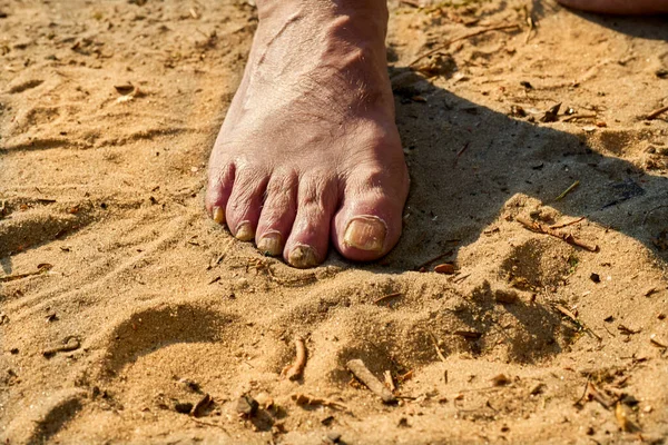 Stopa starszego mężczyzny ze złamanymi gwoździami na piasku — Zdjęcie stockowe