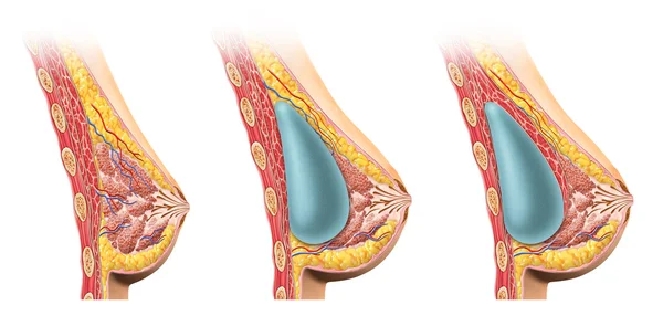 Woman breast implant cross section. — Stock Photo, Image