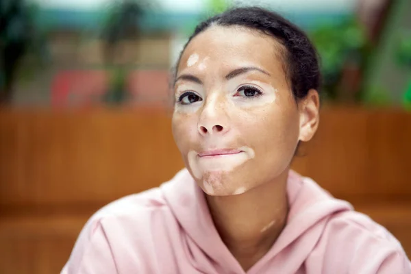 Schwarz Afrikanisch Amerikanische Frau Mit Vitiligo Pigmentierung Hautproblem Drinnen Gekleidet — Stockfoto