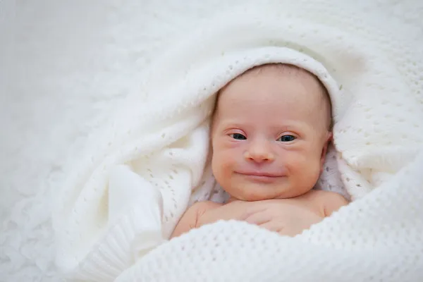 Baby with Down syndrome looks carefully and deliberately — Stock Photo, Image