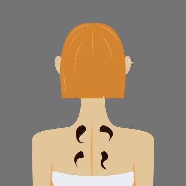 Vektör grafikler, arkasında çıplak omuzlar ve derisinde dört siyah sülük olan, arkadan saç stili olan sarışın bir kadının kafasının arkası. Konsept - hirudotherapy - alternatif tıp