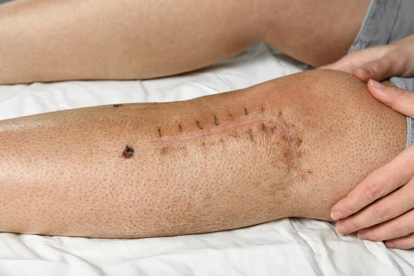 Postoperative Suture Woman Leg Closeup Scar Knee Fracture Traces Interrupted —  Fotos de Stock