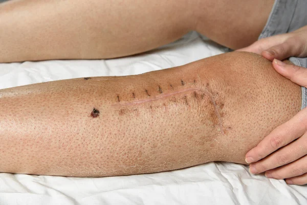 Postoperative Suture Woman Leg Closeup Scar Knee Fracture Traces Interrupted — Foto Stock