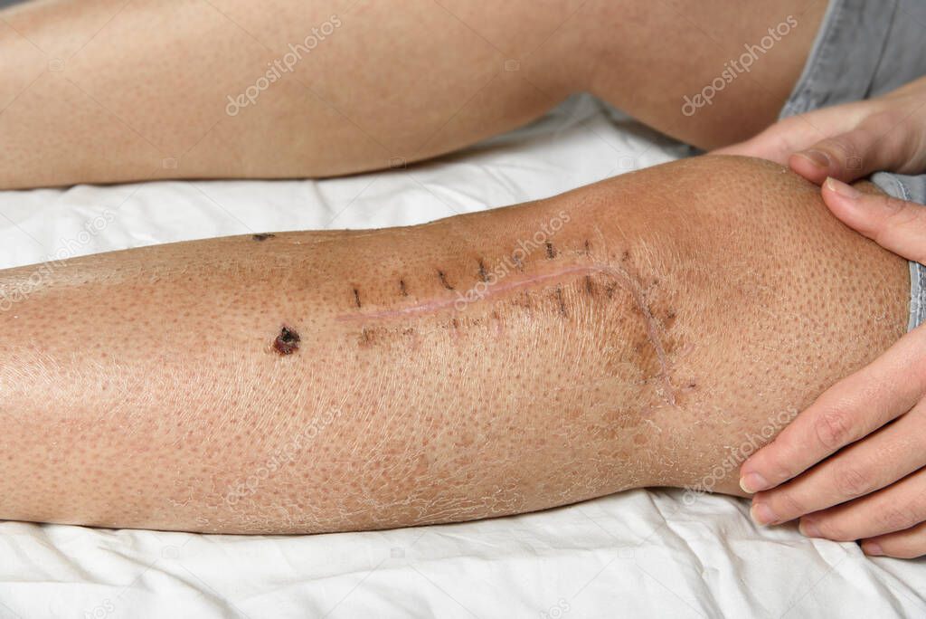 Postoperative suture on woman's leg. Closeup of scar after knee fracture. Traces of interrupted sutures leg after surgery. Recovery and wound healing concept