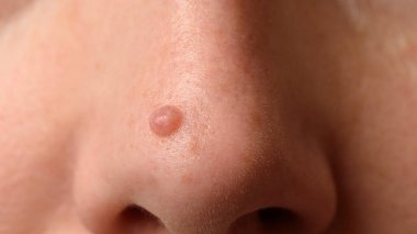 Kadının suratındaki ben ya da nevus. Yakın çekim.