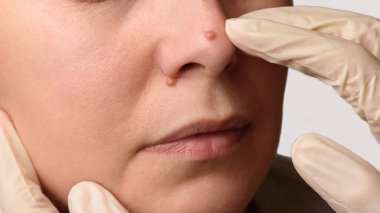 Deri beninin teşhisi ya da kadının yüzündeki nevus. Doktorun elleri ameliyat eldivenlerinde, nevi 'nin burnunu inceliyor. Köstebek konseptini kontrol ediyorum. Yakın çekim.
