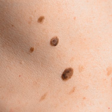 İnsan vücudunda deri lekesi. Esmer nevi ya da nevus. Köstebek konseptini kontrol et. Yakın çekim.