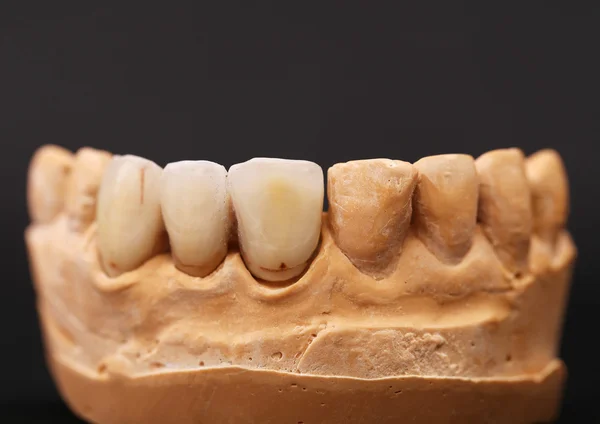 Impressão dentária — Fotografia de Stock