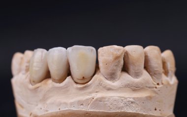 Diş prothetic çeneni kapat.