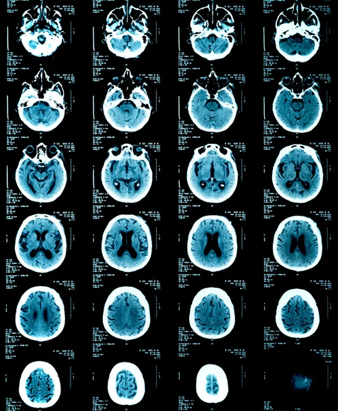 Brain x-rays of an adult person — Stock Photo, Image