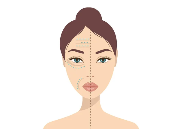 Hyaluronic Acid Facial Injection Vector Infographics Design Template 아름다움 우주론 — 스톡 벡터