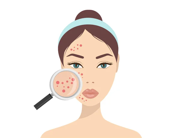 Acne Skin Problems Woman Holding Magnifying Glass Looking Cystic Acne — Stock Vector